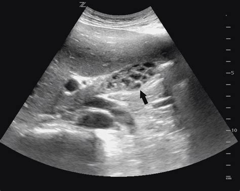 Incidental Diagnosis of Honeycomb Gallbladder on Point-of-Care Ultrasound | Cureus