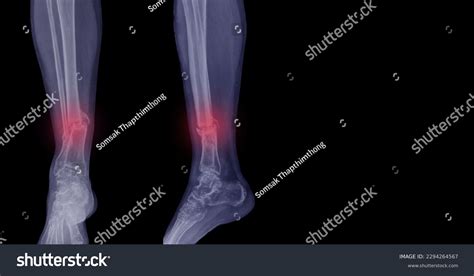 Femur Xray Diagnose Abnormalities Fracture Distal Stock Photo ...