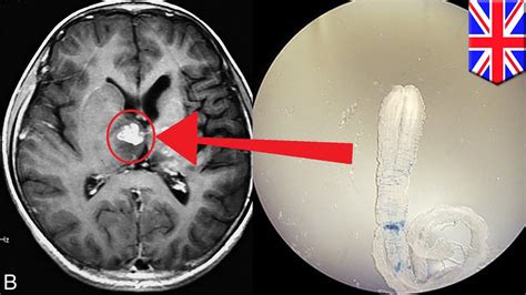 Tapeworm infection: Rare brain worm took 4 years to crawl across UK man’s brain - YouTube