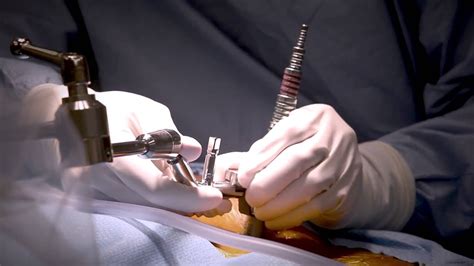 Minimally Invasive Laminectomy Surgery to Treat Lumbar Stenosis ...