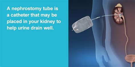 Nephrostomy Tube | My Kidney Stone | Boston Scientific