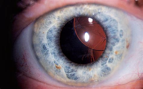 A superiorly subluxated intraocular lens. | Eye health, The incredibles, Oculus