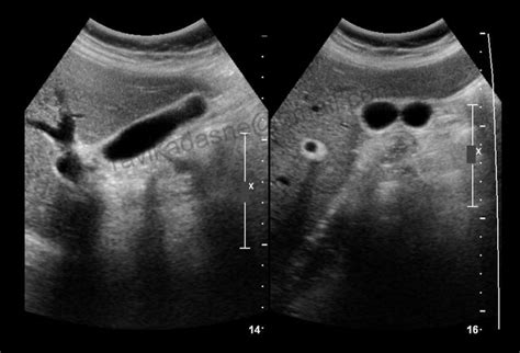 Folded Gallbladder-Ultrasound - Sumer's Radiology Blog