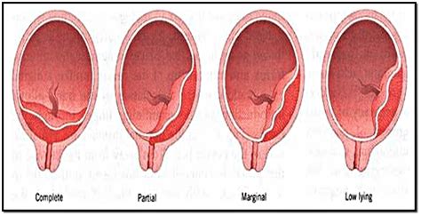 MIDWIFE WANNA BE : MAKALAH SULOSIO PLASENTA, PLASENTA PREVIA & RETENSIO ...