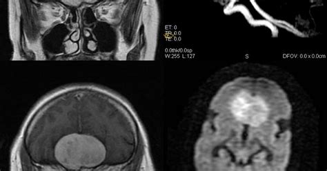 Dr Balaji Anvekar's Neuroradiology Cases: Olfactory groove Meningioma MRI