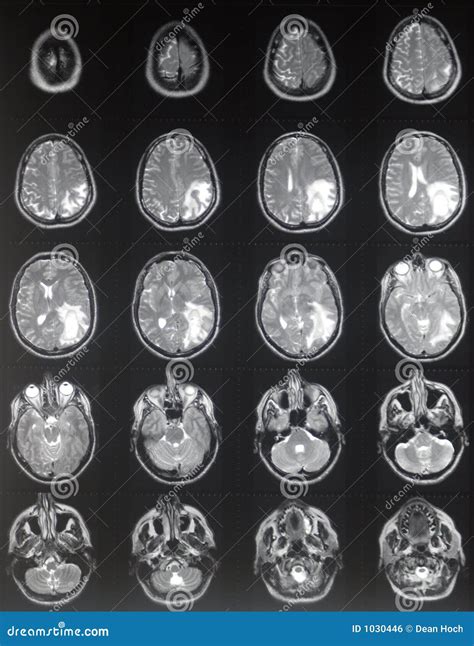 MRI brain tumor stock photo. Image of resonance, transaxial - 1030446