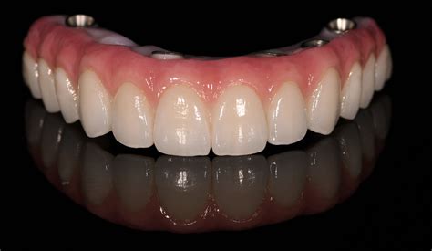 Dental Implants All on 4 All on 6 All On 8+