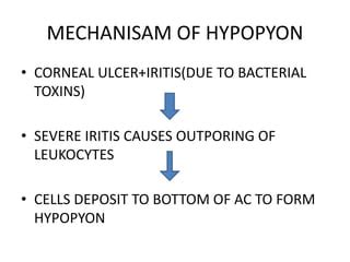 HYPOPYON CORNEAL ULCER | PPT