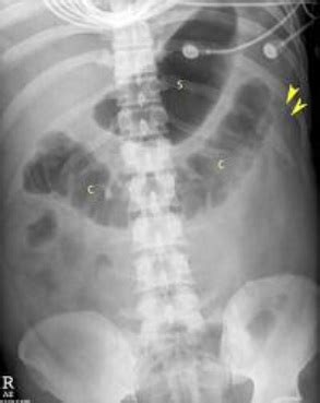 Acute Pancreatitis: Xray - Acute Abdomen Tutorial