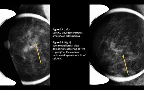 Benign Breast Calcifications Article