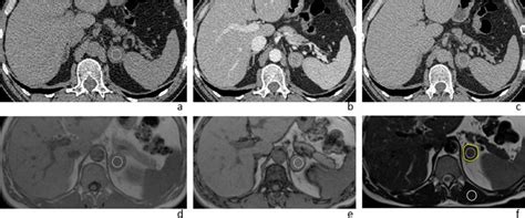 56-year-old male with left lipid-poor adrenal adenoma. Axial-unenhanced... | Download Scientific ...