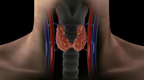 Parathyroid-gland-location-Dr-Larian - Hyperparathyroidism Surgery - Dr. Babak Larian