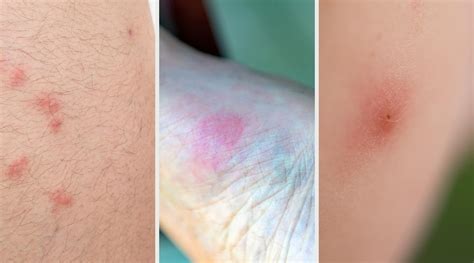 Bug Bite Comparison: Fleas vs. Bed Bugs vs. Mosquitoes