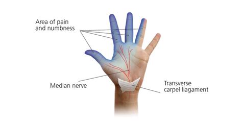 Carpel tunnel syndrome (CTS) in pregnancy - South Tees Hospitals NHS Foundation Trust