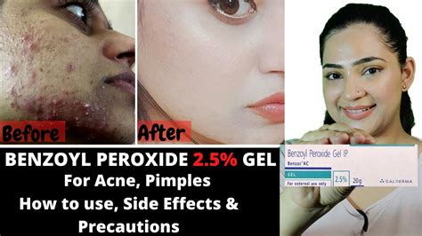 Benzoyl peroxide Uses & Side Effects | Gel for Ance / Pimples / Clogged ...