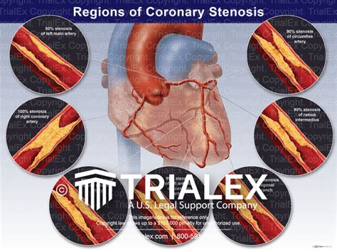 Regions of Coronary Stenosis - TrialExhibits Inc.