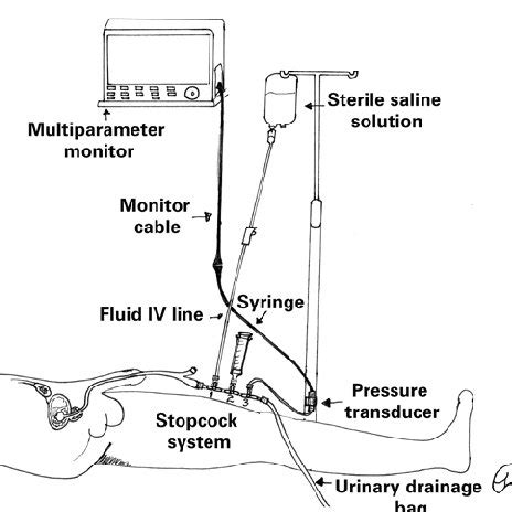 (PDF) Intra-abdominal pressure: an integrative review