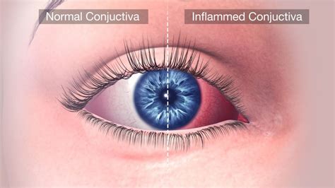 Allergic conjunctivitis: Symptoms, Types, Causes And Treatment