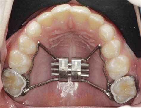 ORTODONCIA INFANTIL: TIPOS DE TRATAMIENTOS | Clínica Dental en Sevilla 2023 | IMOA Dentistas de ...