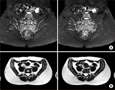 MRI of sacroiliac joint and pelvis. (A) Coronal view of the T2-weighted ...