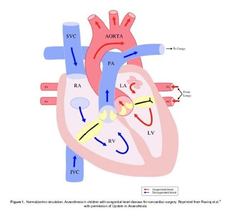 Anaesthesia in Children With Congenital Heart Disease for Noncardiac ...