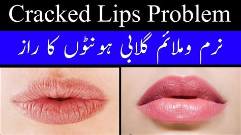 Amazing Hack To Smooth Dry Chapped Lips | How To Get Rid Of Dry Lips Instantly | Dry Cracked ...