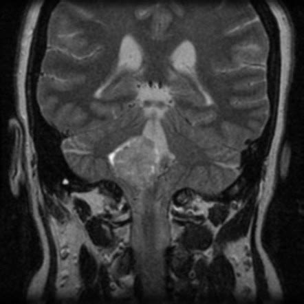 Choroid plexus papilloma | Image | Radiopaedia.org