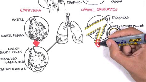 Chronic Obstructive Pulmonary Disease Overview (types, pathology, treatment) - Medical Discover