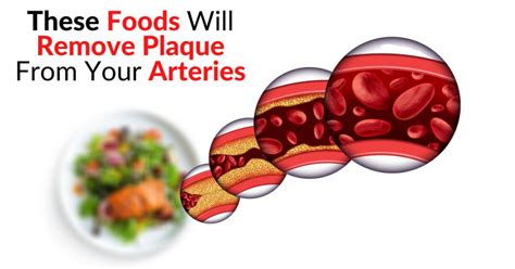 These Foods Will Remove Plaque From Your Arteries | Dr. Sam Robbins