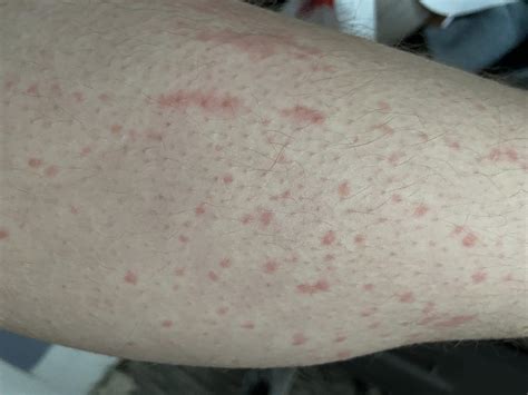 Does anyones cold hives look like this. When my legs are exposed to ...