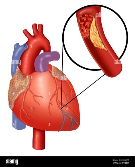 Heart attack showing blood clot Cut Out Stock Images & Pictures - Alamy