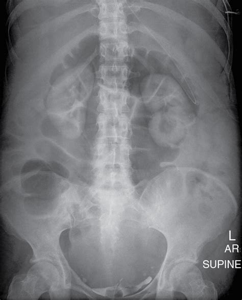 Abdominal radiography | Radiology Key