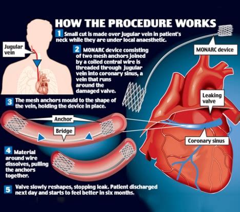 End of open heart surgery for sufferers of 'leaky valves' after first UK operation | Daily Mail ...