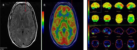 Seizure Brain Scan