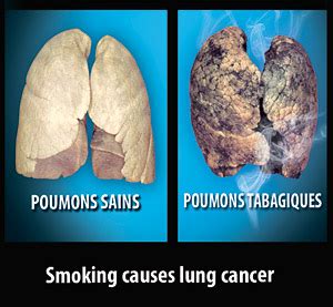 Smoking causes lung cancer - Mauritius