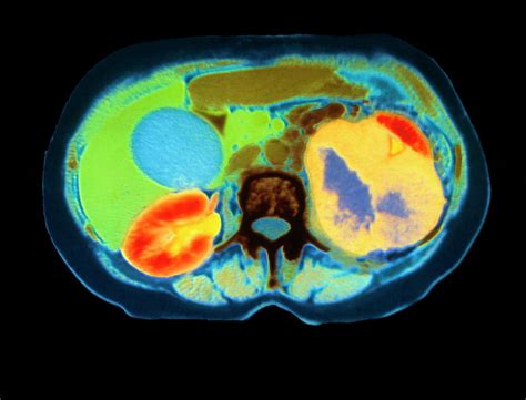 Col Ct Scan Showing Kidney Cancer (axial Section) Photograph by Dept ...