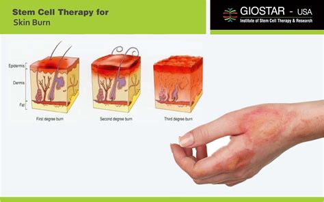 Stem Cell Therapy for Skin Burn, Treatment for Skin Burn in India