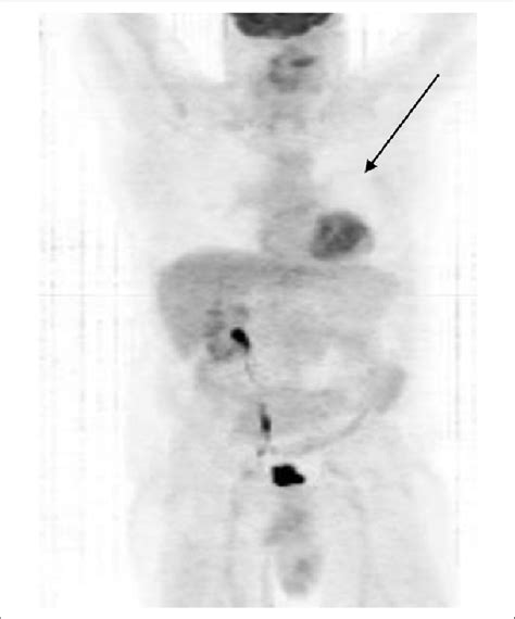 PET/CT scan, January 2014. | Download Scientific Diagram