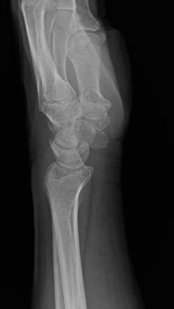 Triquetral Fracture Radiology