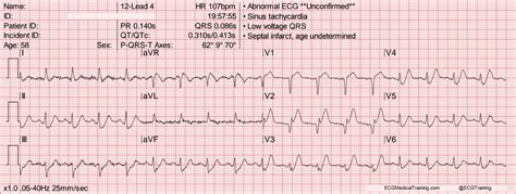 De Winter ST/T-Waves - ECG Medical Training