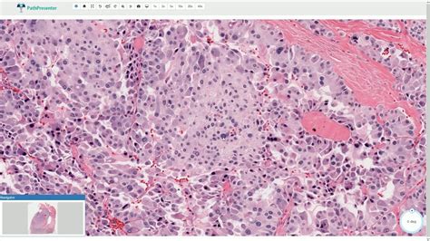 Medullary Carcinoma - Thyroid Gland, Histopathology - YouTube