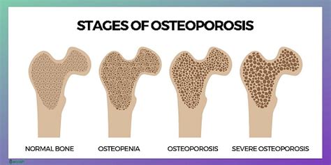 Osteoporosis Causes Symptoms Types And Osteopenia | Porn Sex Picture