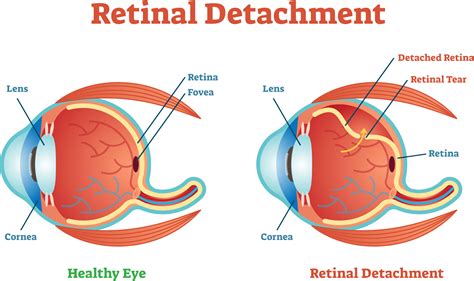 Retinal Diseases - Retina Consultants of New Orleans