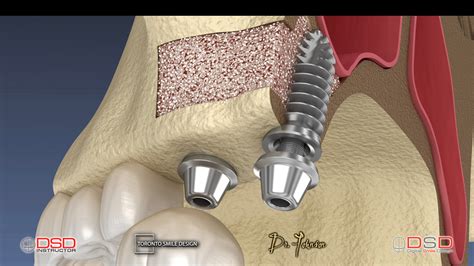 Sinus Lift - Bone Grafting for Dental Implants - Yorkville Oral Surgery