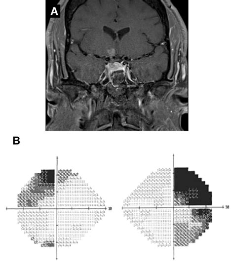 Vision Loss Due to Herniation of the Optic Chiasm | Duke Health Referring Physicians