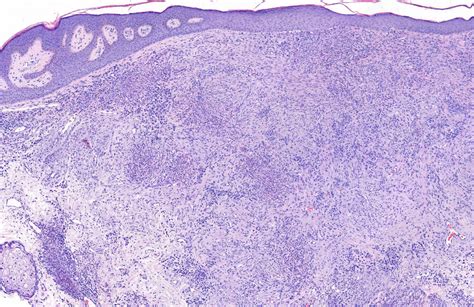 Pathology Outlines - Granuloma faciale