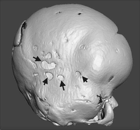 Example of cranial lacunae on 3DR CT. Some example lacunae are ...