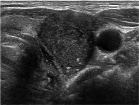 Thyroid US showing a markedly hypoechoic solid nodule that is taller... | Download Scientific ...