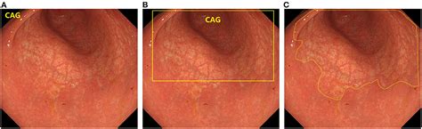 Frontiers | Diagnostic value of artificial intelligence-assisted endoscopy for chronic atrophic ...