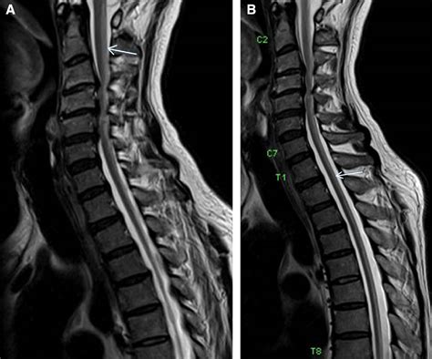 Subacute Combined Degeneration of the Spinal Cord - The American ...